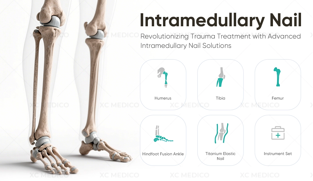 Интрамедуллярный гвоздь