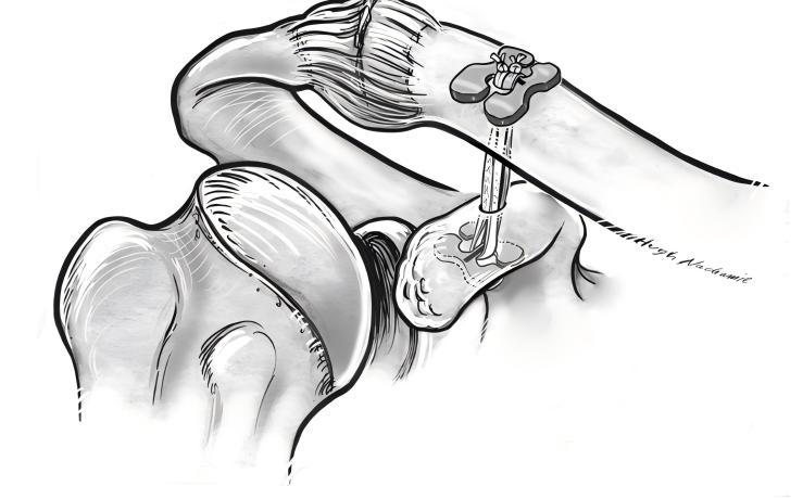 Ремонт титановой пластины