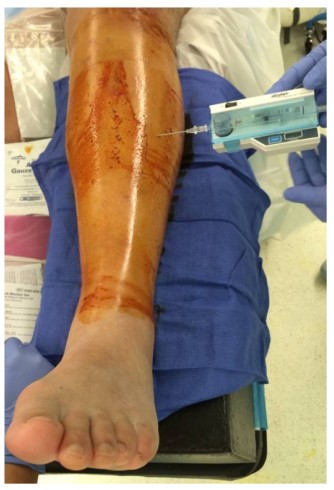 Техника интрамедуллярной фиксации гвоздей на большеберцовой кости