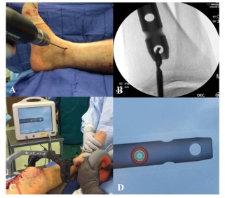 Техника фиксации интрамедуллярных гвоздей большеберцовой кости-11