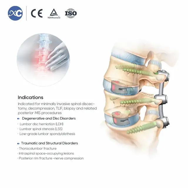Набор инструментов MIS Spinal Portal для минимально инвазивной хирургии позвоночника