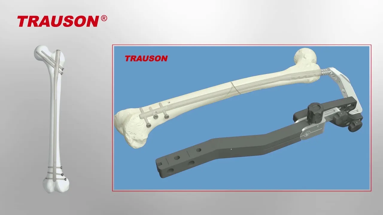 Trauson.webp