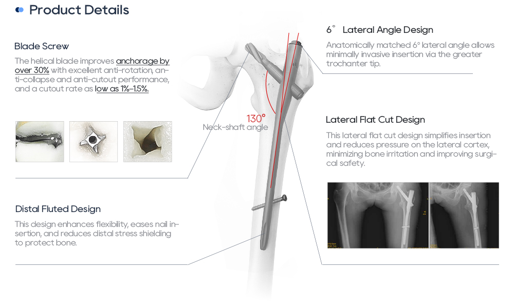 Интрамедуллярный стержень PFNA | Фиксация перелома проксимального отдела бедренной кости 