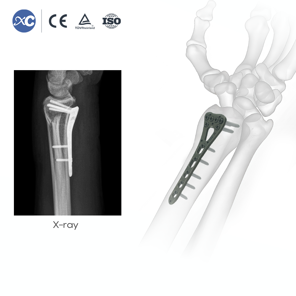 Набор инструментов для дистального радиуса