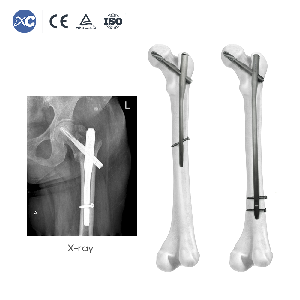 Интрамедуллярный гвоздь PFNA