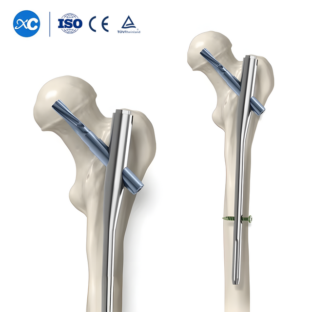 Интрамедуллярный гвоздь PFNA