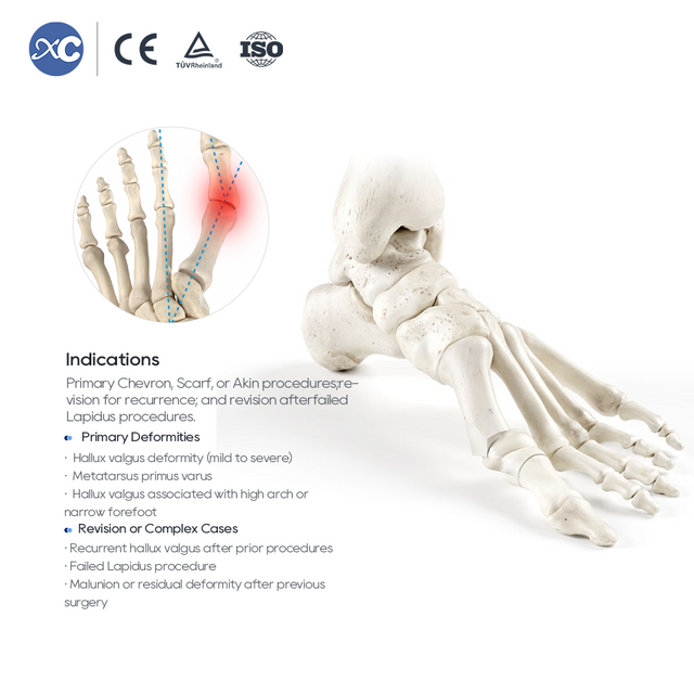 Набор инструментов для остеотомии Hallux Valgus MIS
